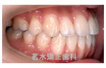 矯正治療後写真g2
