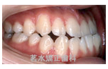 矯正治療前写真g2