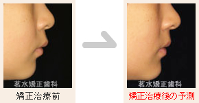 矯正治療後の予測