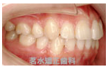 矯正治療後写真b2
