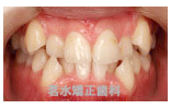 矯正治療前写真b1
