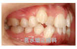 矯正治療前写真b2