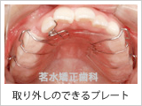 取り外し可能な装置