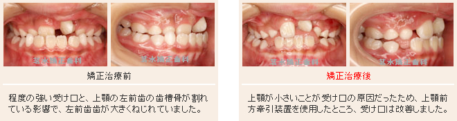 受け口の治療例