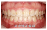矯正治療後写真f1