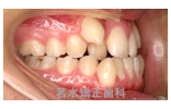 矯正治療前写真e2