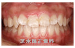 矯正治療前写真f1