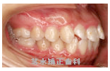 矯正治療前写真f2