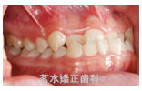 矯正治療前写真h3