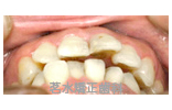 矯正治療前写真l3